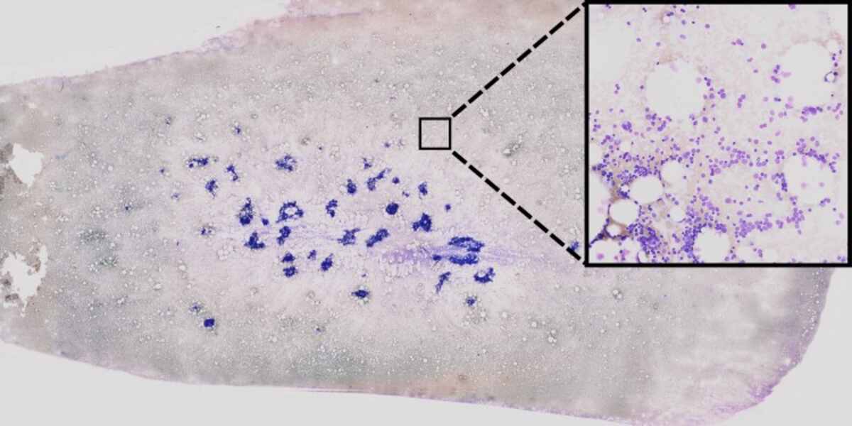 The use of AI-based processing of bone-marrow smears is being explored to assist in the diagnosis of leukemia. This involves the extraction of single-cell images from high-resolution data through unsupervised learning methods. The cell images are then analyzed using neural networks to identify any visual anomalies that may have a genetic origin. The neural network highlights important areas for decision-making using "explainable AI" strategies, which are indicated by colored highlights. The credit for this image goes to AG Risse.