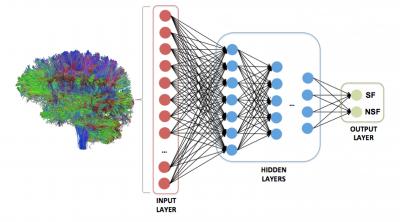 CAPTION The figure shows a personalized structural connectome; the strength of each connection between all possible brain regions is used to train a deep neural network to predict one of two outcomes: seizure freedom (SF) or seizure refractoriness (NSF).  CREDIT Dr. Ezequiel Gleichgerrcht and Dr. Leonardo Bonilha of the Medical University of South Carolina