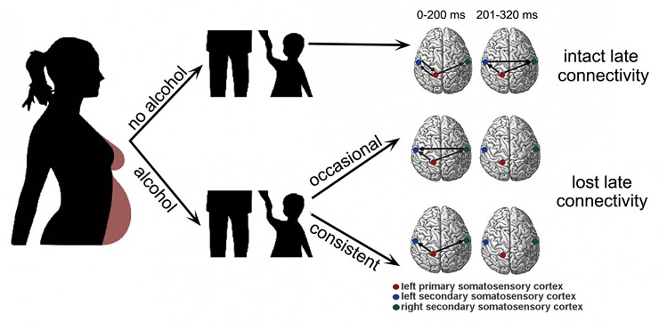 CAPTION Schematic representation of the presented results a paper in the journal Chaos. We compare somatosensory evoked MEG response time series of children with/without prenatal alcohol exposure. The reconstructed networks of the primary (red dot) and secondary (blue and green dots) somatosensory cortex show a lack of inter-hemispheric connectivity in the late response (201-320 ms after stimulus) for children prenatally exposed to alcohol.  CREDIT Gao Lin and Linda Sommerlade