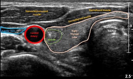 CAPTION Ultrasound image of thyroid nodule.  CREDIT Dr. Elizabeth Cottril, Thomas Jefferson University