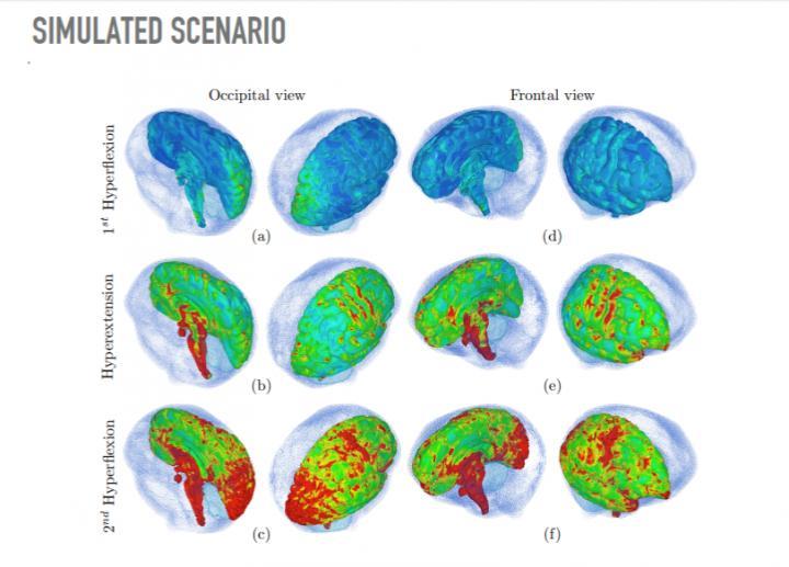 CAPTION During hyperflexion on the second shake, the fluid did not have enough time to reach the affected areas. In other words, following the first shake, the CSF was unable to prevent the brain from colliding with the skull, suggesting that the fluid offers no protection at repeated frequencies.  CREDIT Milan Toma