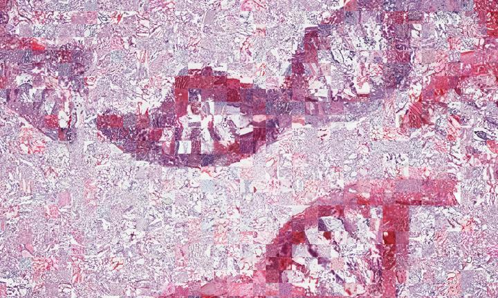 CAPTION A mosaic of tumour microscopy images forming broken DNA molecules.  CREDIT Credit: Yu Fu, Moritz Gerstung, Spencer Phillips/EMBL