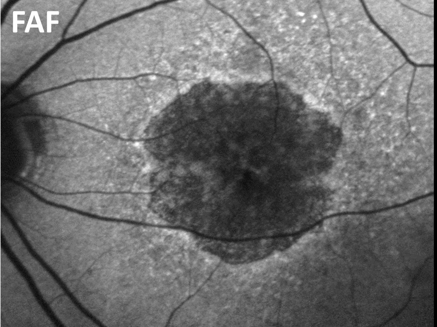 CAPTION Image of the central retina in a patient with geographic atrophy - serves as a reference for optical coherence tomography (OCT).  CREDIT © Universitäts-Augenklinik Bonn