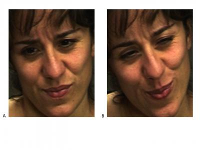 Which expression do you think shows real pain? Attempts to fake expressions of pain typically involve the same facial muscles that are contracted during real pain. There is no telltale facial muscle whose presence or absence would indicate real or faked pain. The difference is in the dynamics. Human observers are at chance for telling them apart. The machine learning and computer vision system described by Bartlett et al. detects faked pain significantly better than humans. The system detects distinctive dynamic features of expression missed by humans. Spontaneous and deliberate facial movement is controlled by distinct motor pathways that differ in their dynamics. By revealing the dynamics of facial action through machine vision systems, the approach in Bartlett et al has the potential to elucidate behavioral fingerprints of neural control systems involved in emotional signaling. The real expression of pain is image B on the right. Credit: Kang Lee, Marian Bartlett Which expression do you think shows real pain? Attempts to fake expressions of pain typically involve the same facial muscles that are contracted during real pain. There is no telltale facial muscle whose presence or absence would indicate real or faked pain. The difference is in the dynamics. Human observers are at chance for telling them apart. The machine learning and computer vision system described by Bartlett et al. detects faked pain significantly better than humans. The system detects distinctive dynamic features of expression missed by humans. Spontaneous and deliberate facial movement is controlled by distinct motor pathways that differ in their dynamics. By revealing the dynamics of facial action through machine vision systems, the approach in Bartlett et al has the potential to elucidate behavioral fingerprints of neural control systems involved in emotional signaling. The real expression of pain is image B on the right. Credit: Kang Lee, Marian Bartlett