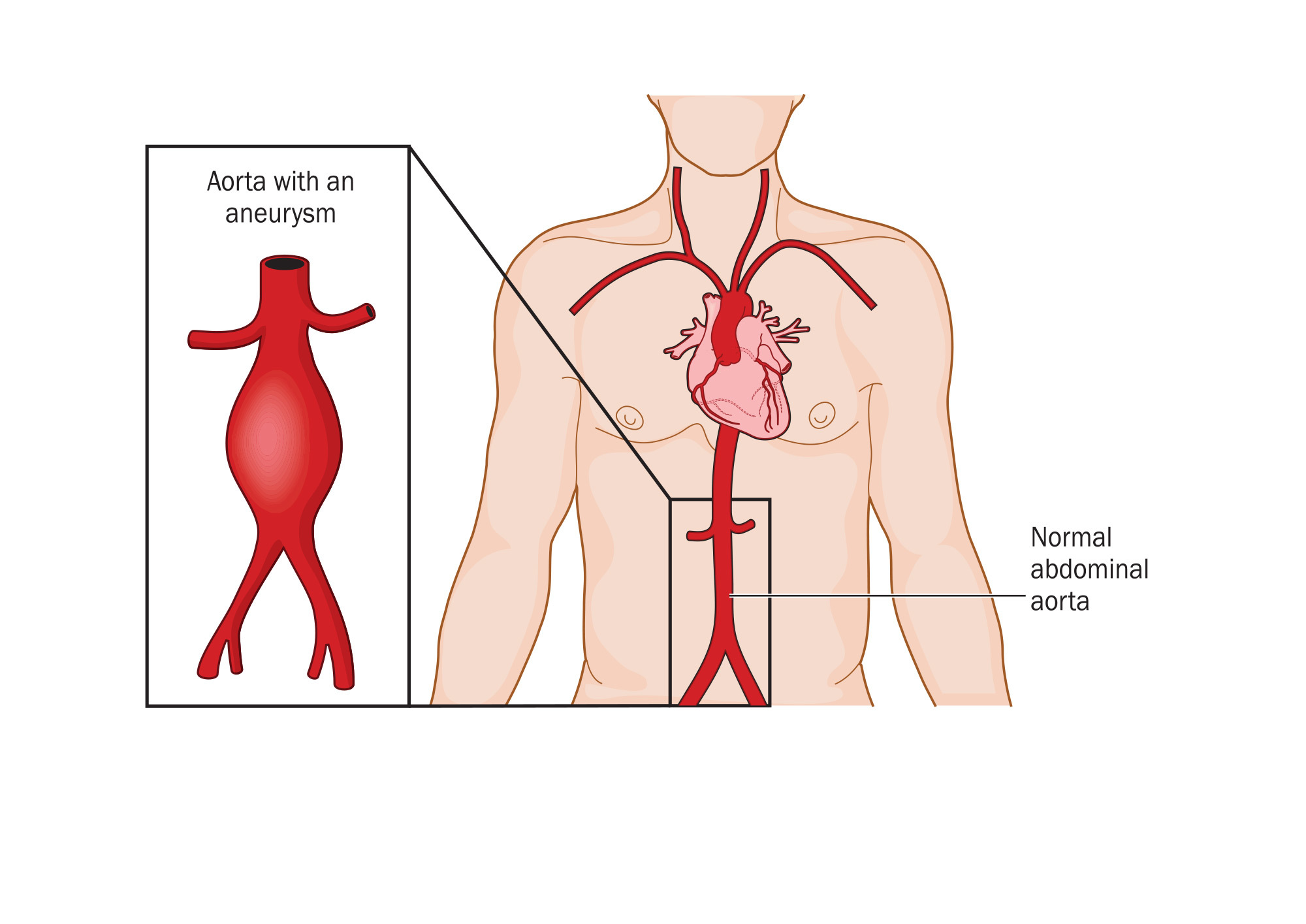 Location and comparison of a normal aorta and abdominal aortic aneurysm. If left untreated the aneurysm will irreversibly grow increasing risk of rupture for a patient. Credit: Shutterstock.