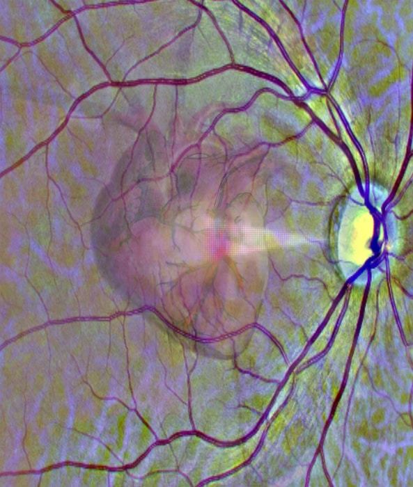 A graphical representation of the idea of using a scan of the eye to get a window into heart health.