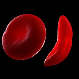 Sickle cell disease: Normal red blood cell (left) and sickled red blood cell (right)