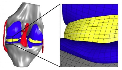 Erdemir’s finite element model of the knee joint with representation of the cartilage, menisci and the associated bone structures. An enlarged model region (right) illustrates the mesh resolution of the simulation. (Erdemir/Cleveland Clinic)